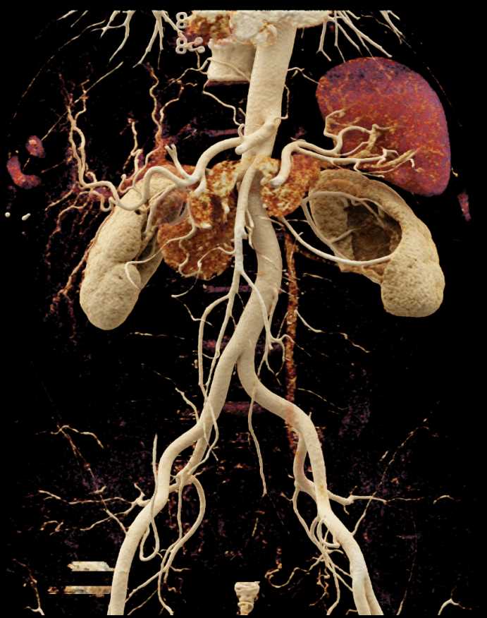 Ureteropelvic Junction (UPJ) Left Renal Pelvis - CTisus CT Scan