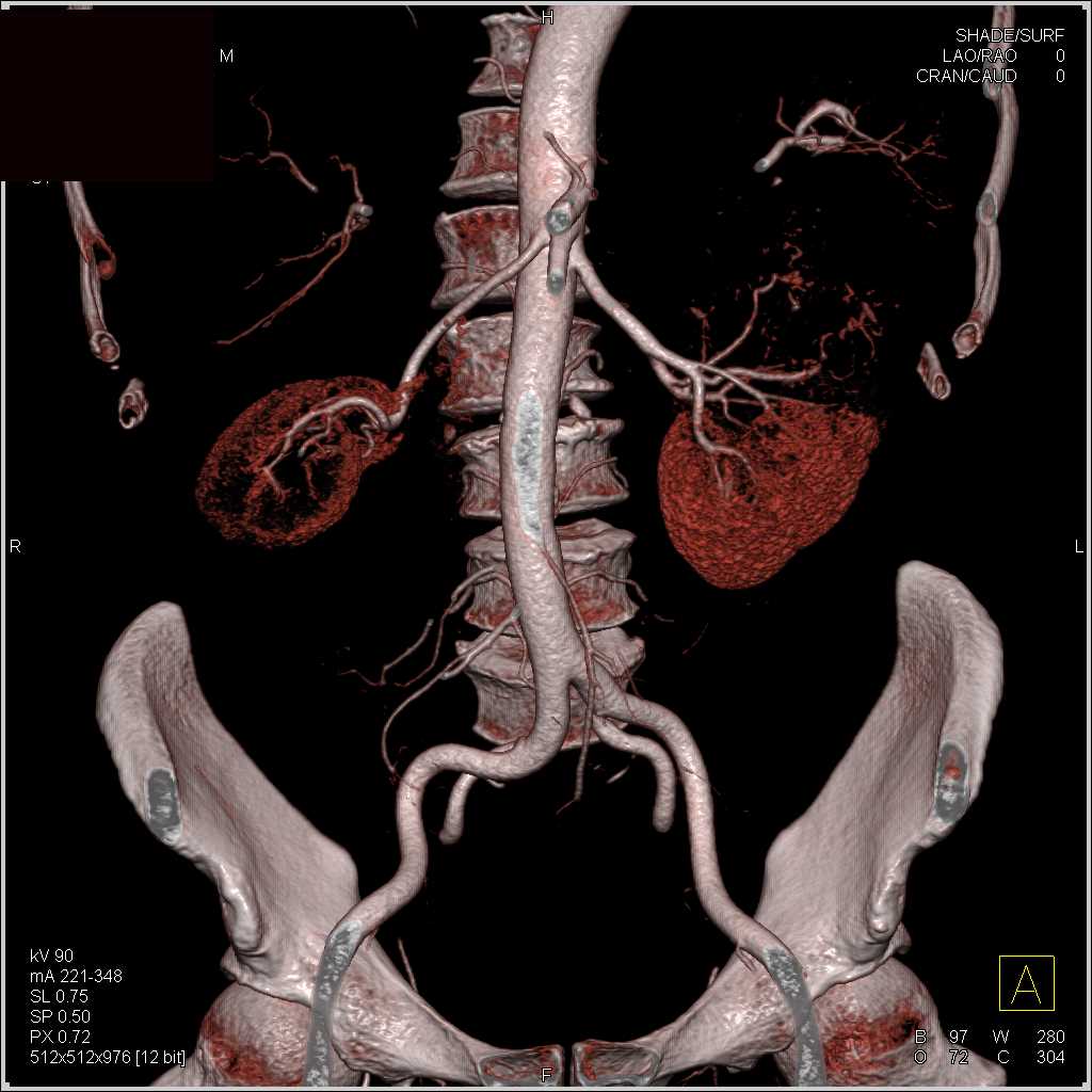 Clear Cell Renal Cell Carcinoma - CTisus CT Scan