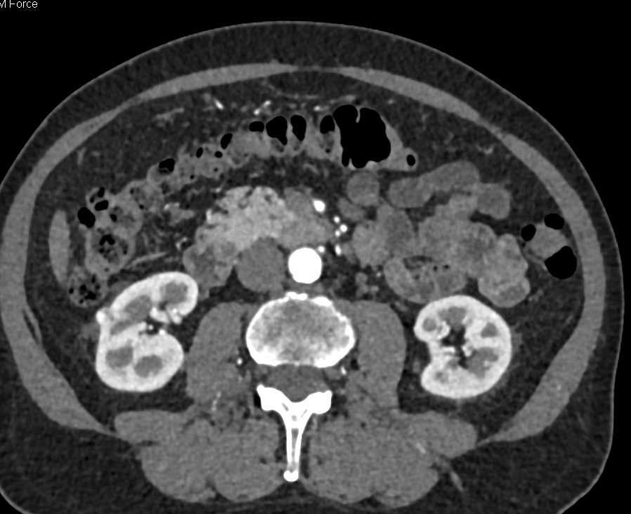 9mm Right Renal Cell Carcinoma - CTisus CT Scan