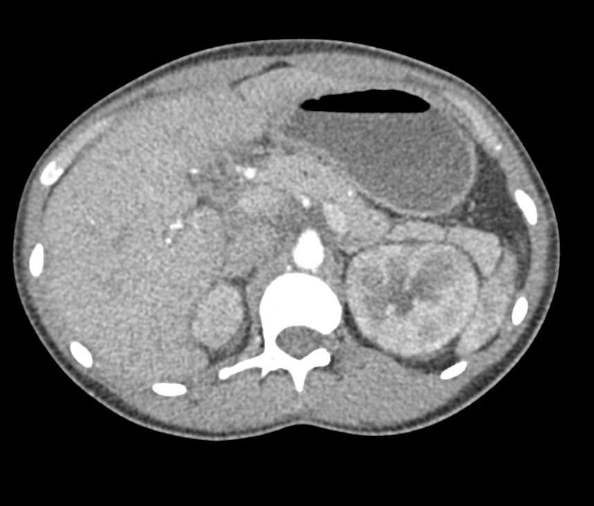 Acute Pyelonephritis Involves Both Kidneys - CTisus CT Scan