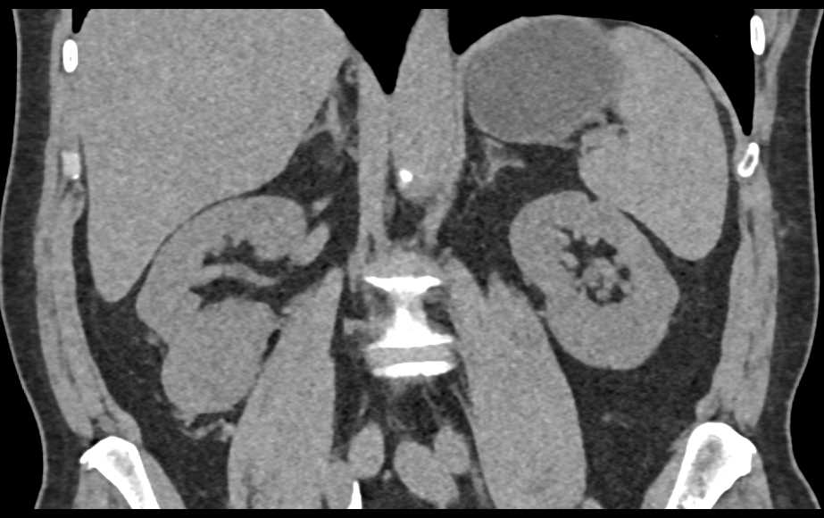 Oncocytoma Lower Pole of the Right Kidney - CTisus CT Scan