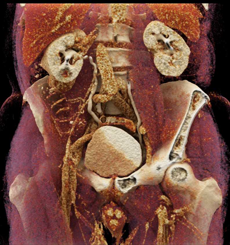 Oncocytoma Lower Pole of the Right Kidney with Cinematic Rendering - CTisus CT Scan