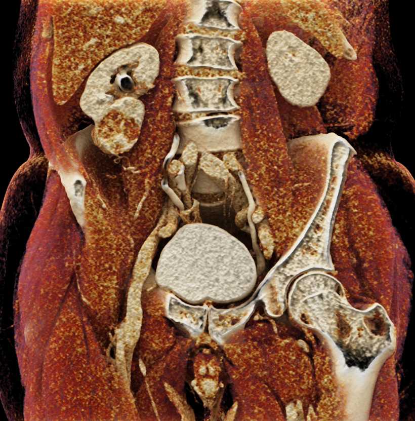 Oncocytoma Lower Pole of the Right Kidney with Cinematic Rendering - CTisus CT Scan