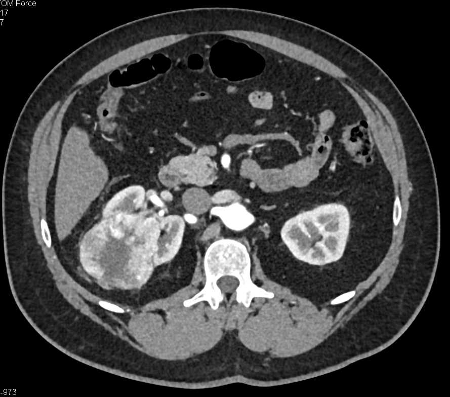 Clear Cell Renal Cell Carcinoma - CTisus CT Scan