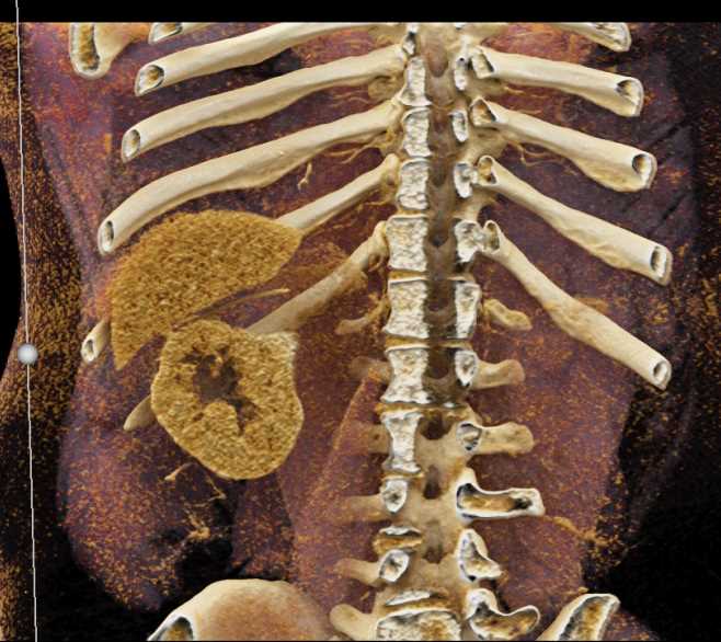 Clear Cell Renal Cell Carcinoma with Cinematic Rendering - CTisus CT Scan