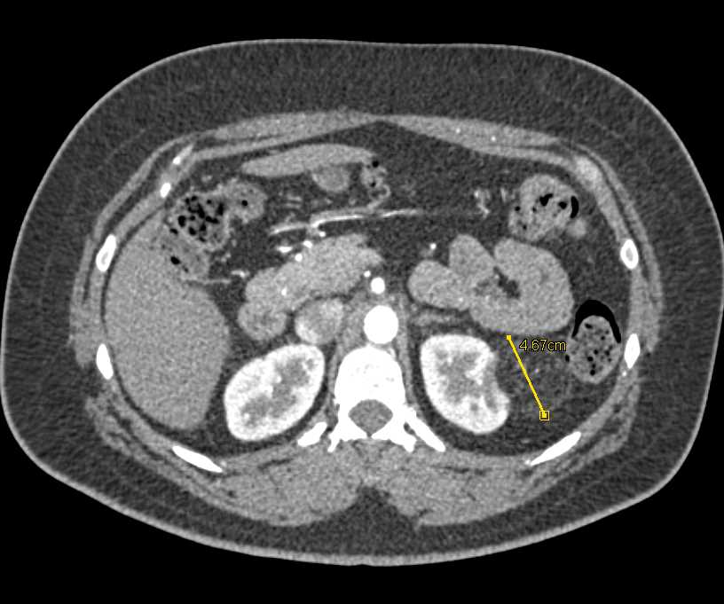 Left Renal Angiomyolipoma (AML) - CTisus CT Scan