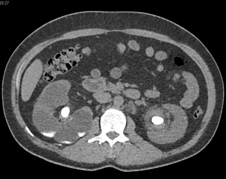 Focal XGP Right Kidney - CTisus CT Scan