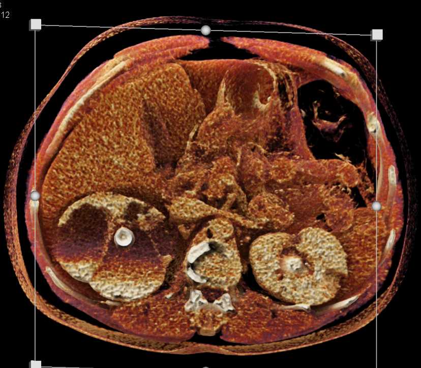 Focal XGP Right Kidney - CTisus CT Scan
