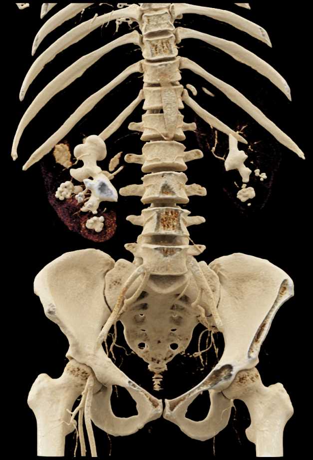 Bilateral Renal Calculi with Cinematic Rendering - CTisus CT Scan