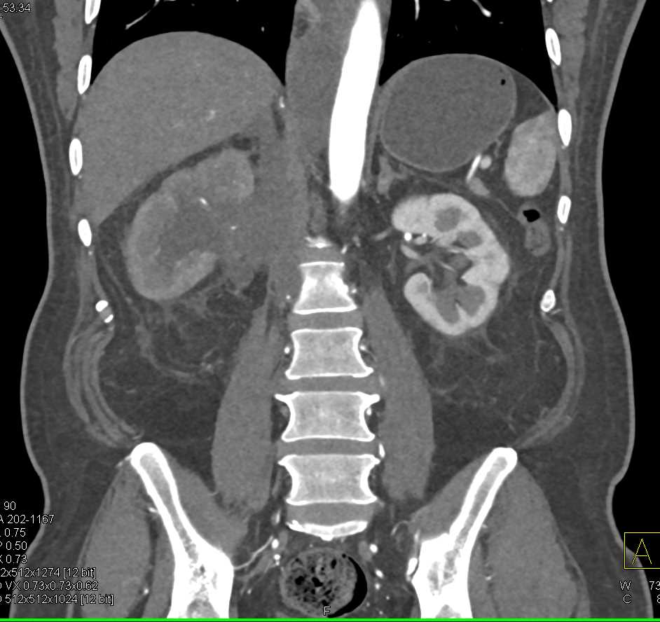 Invasive Renal Cell Carcinoma - CTisus CT Scan