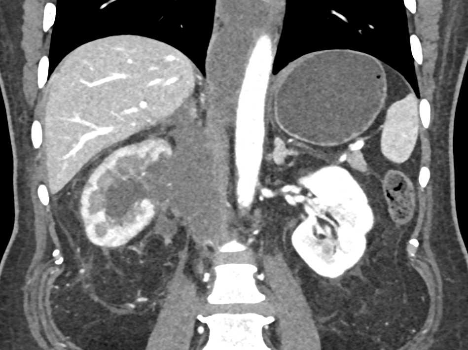 Invasive Renal Cell Carcinoma - CTisus CT Scan