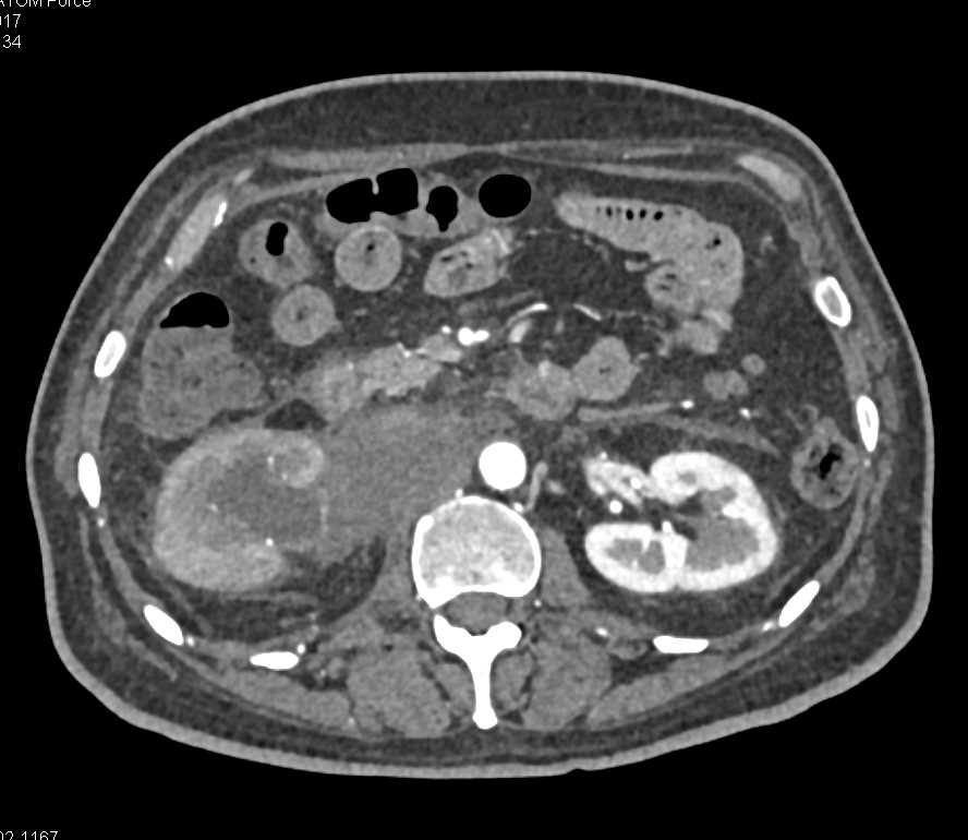 Lymphoma Obstructs the Right Kidney - CTisus CT Scan