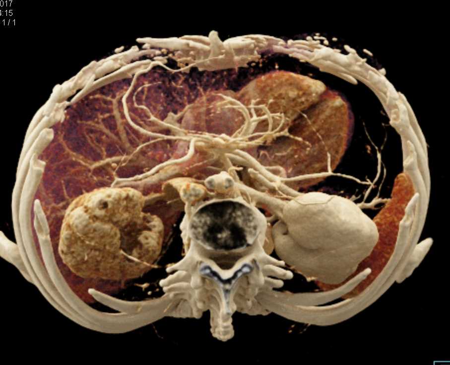 Lymphoma Obstructs the Right Kidney with Cinematic Rendering - CTisus CT Scan