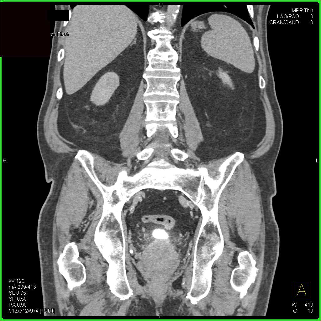 1 Cm Left  Renal Carcinoma - CTisus CT Scan