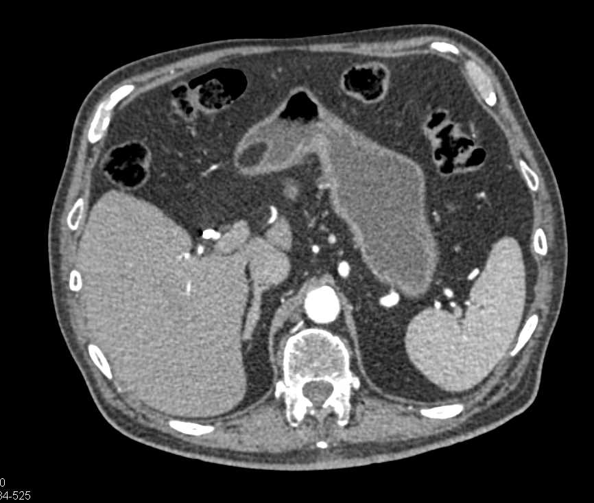 1 Cm Left  Renal Carcinoma - CTisus CT Scan