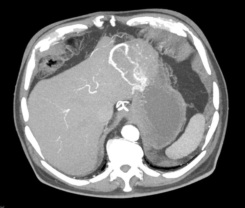 1 Cm Right Renal Carcinoma of High CT Attenuation of the Non Contrast Scans - CTisus CT Scan