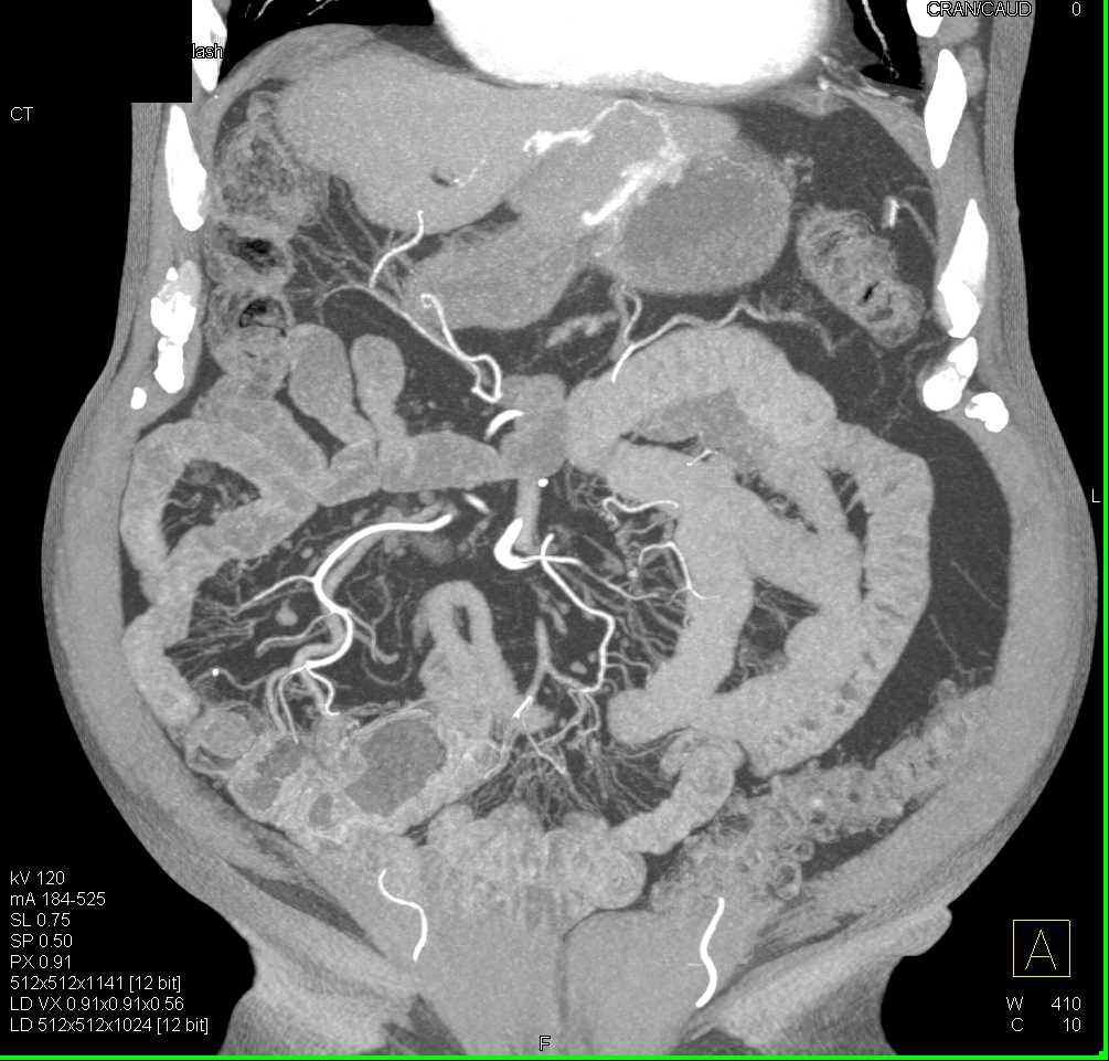 1 Cm Right Renal Carcinoma of High CT Attenuation of the Non Contrast Scans - CTisus CT Scan