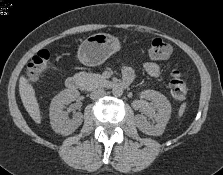 Transitional Cell Carcinoma Left Renal Pelvis - CTisus CT Scan