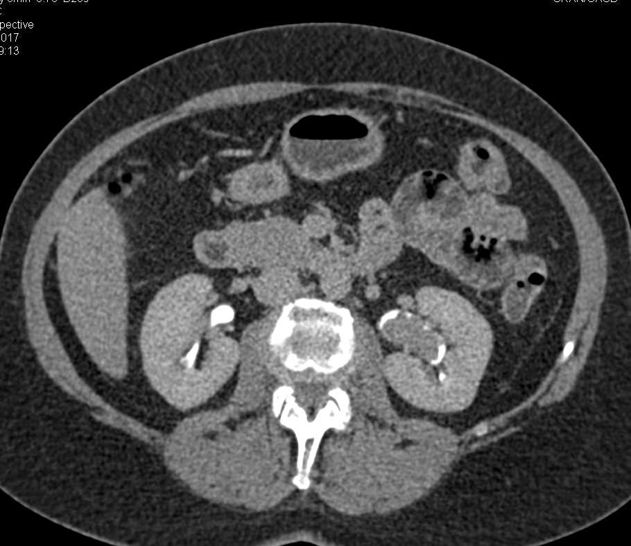 Transitional Cell Carcinoma (TCC) Left Renal Pelvis - CTisus CT Scan