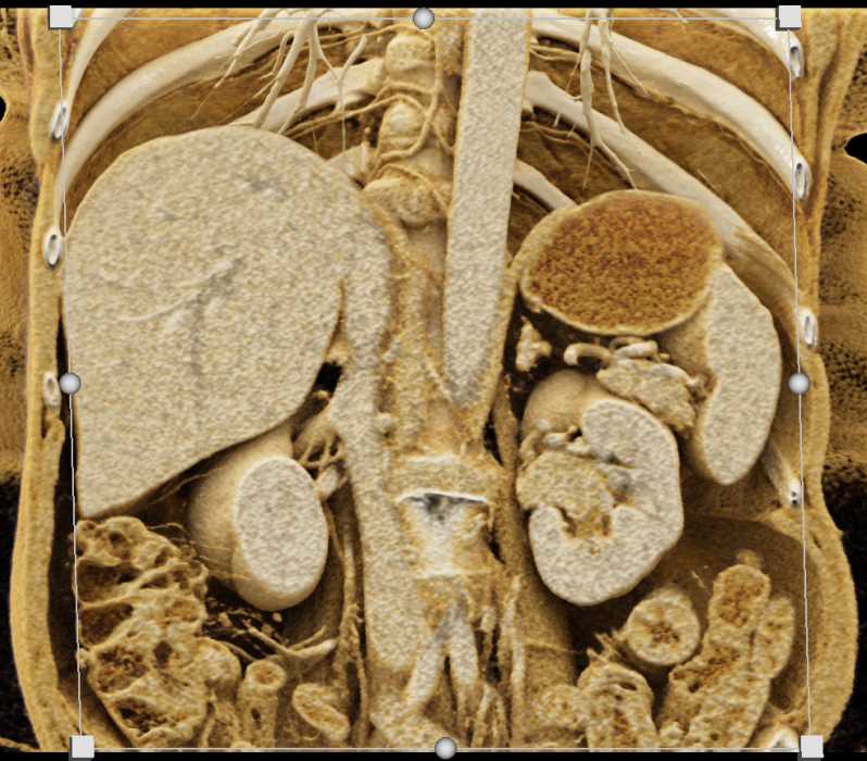 Transitional Cell Carcinoma (TCC) Left Renal Pelvis - CTisus CT Scan