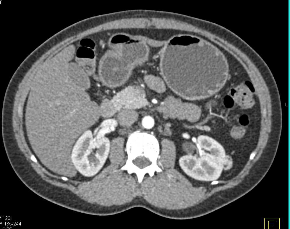 1cm Angiomyolipoma Left Kidney - CTisus CT Scan