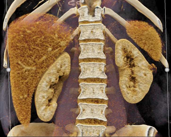 1cm Angiomyolipoma Left Kidney - CTisus CT Scan