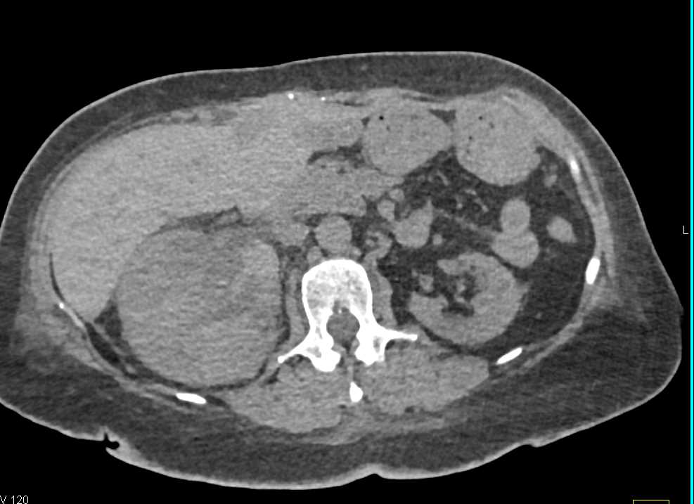 Right Renal Cell Carcinoma - CTisus CT Scan