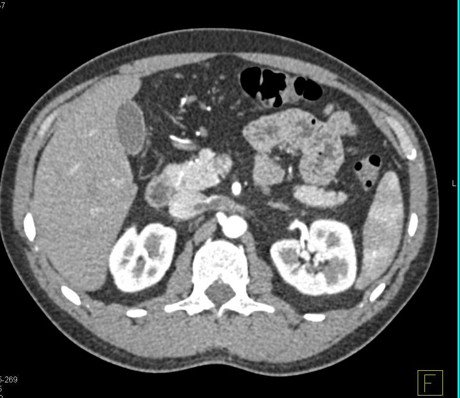 Focal Thrombus Left Renal Vein Into the Inferior Vena Cava (IVC) - CTisus CT Scan