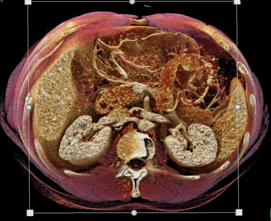 Focal Thrombus Left Renal Vein Into the Inferior Vena Cava (IVC) - CTisus CT Scan