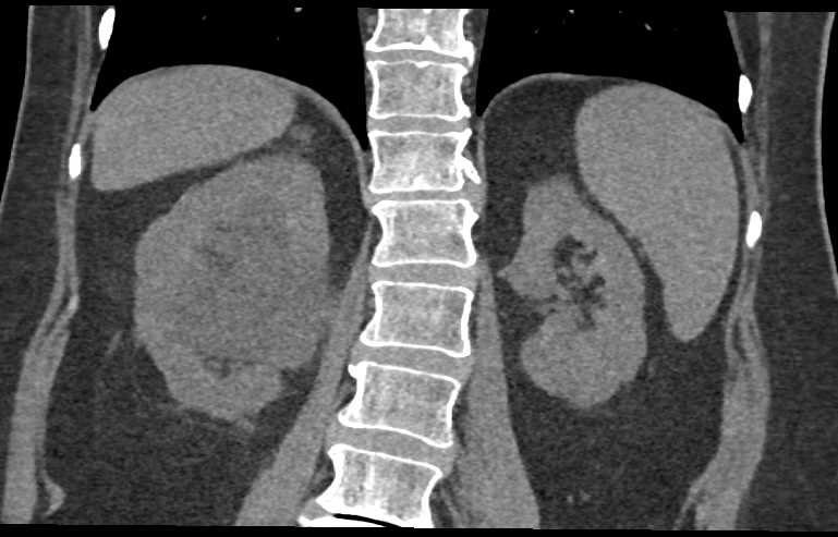 Inflammation Bladder and Ureter - CTisus CT Scan