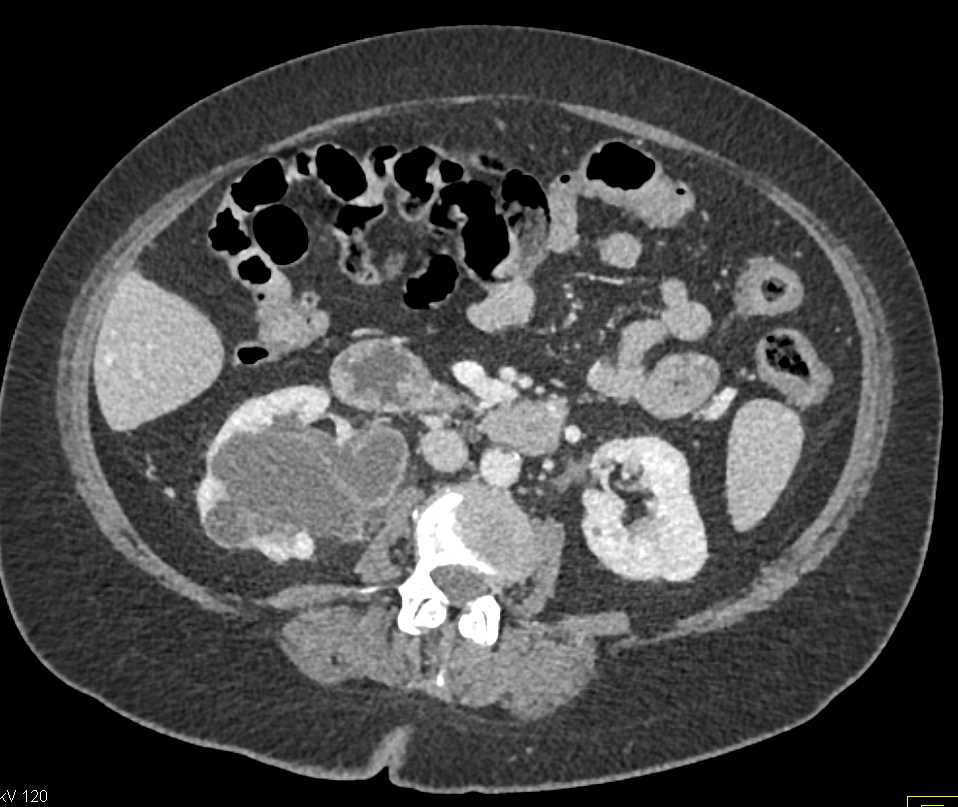 Inflammation Bladder and Ureter - CTisus CT Scan