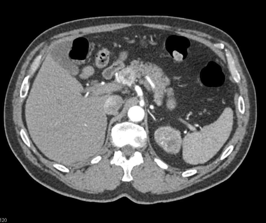 Renal Cell Carcinoma with Liver Metastases - CTisus CT Scan