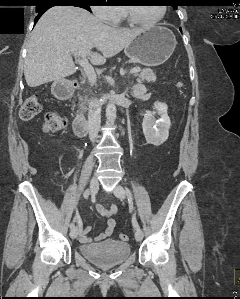 Clear Cell Renal Cell Carcinoma with Renal and Adrenal Metastases - CTisus CT Scan