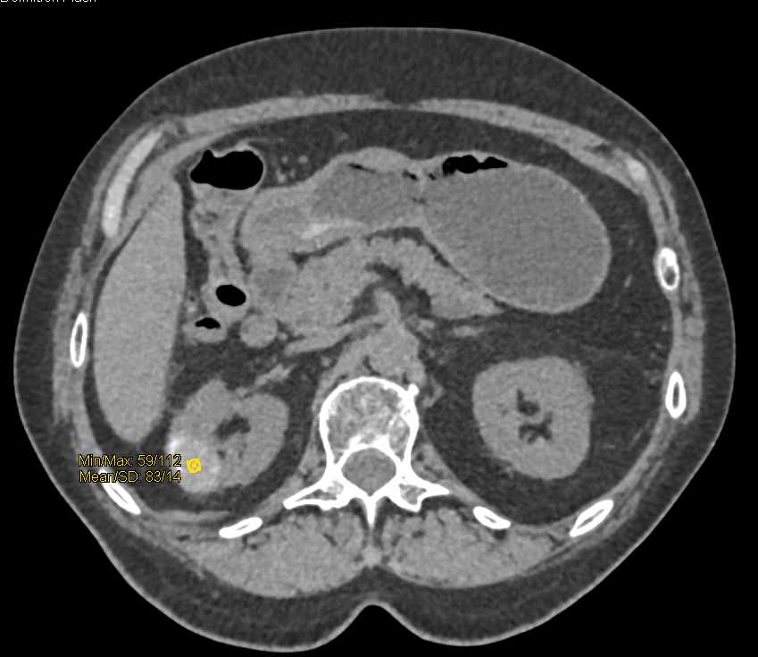 High Density Cyst in the Right Kidney - CTisus CT Scan