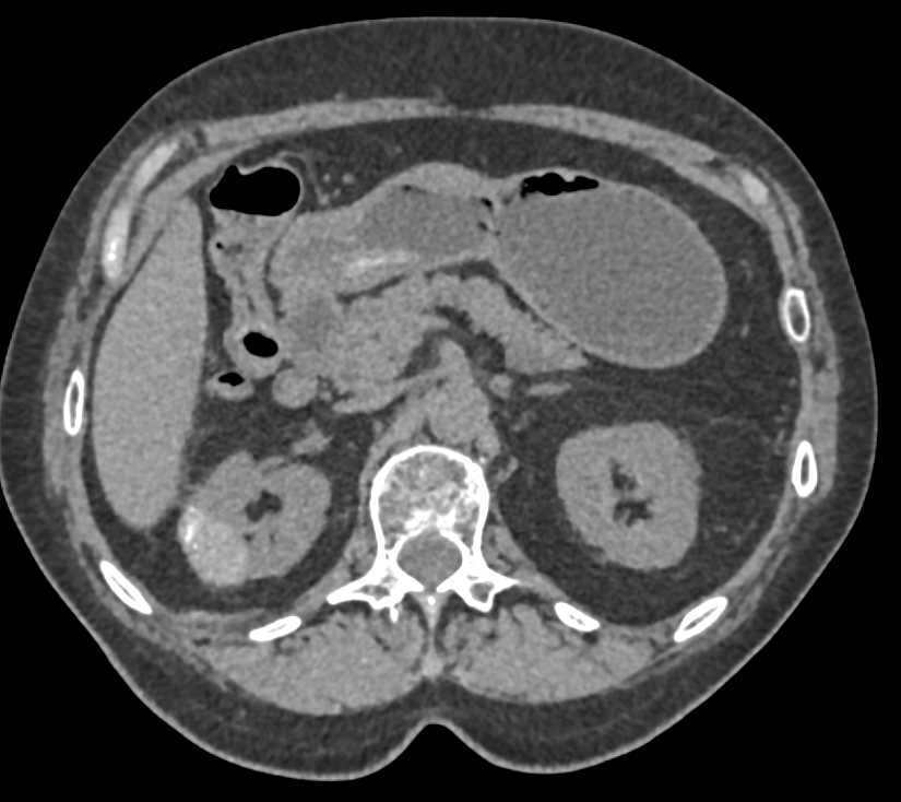 High Density Cyst in the Right Kidney - CTisus CT Scan