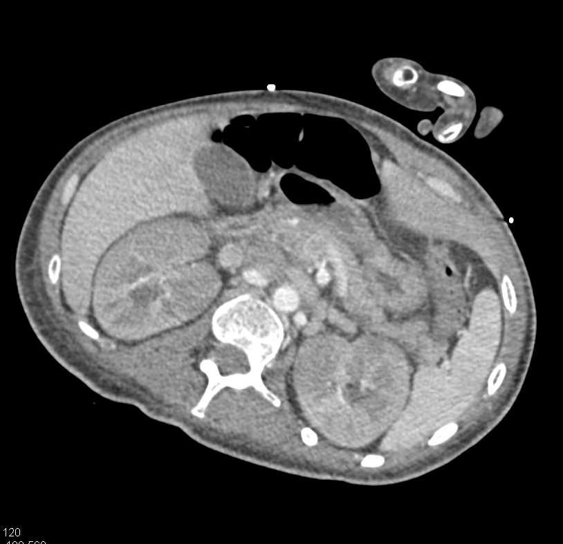 Acute Pyelonephritis Bilaterally - CTisus CT Scan