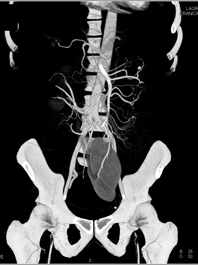 Left Pelvic Kidney - CTisus CT Scan