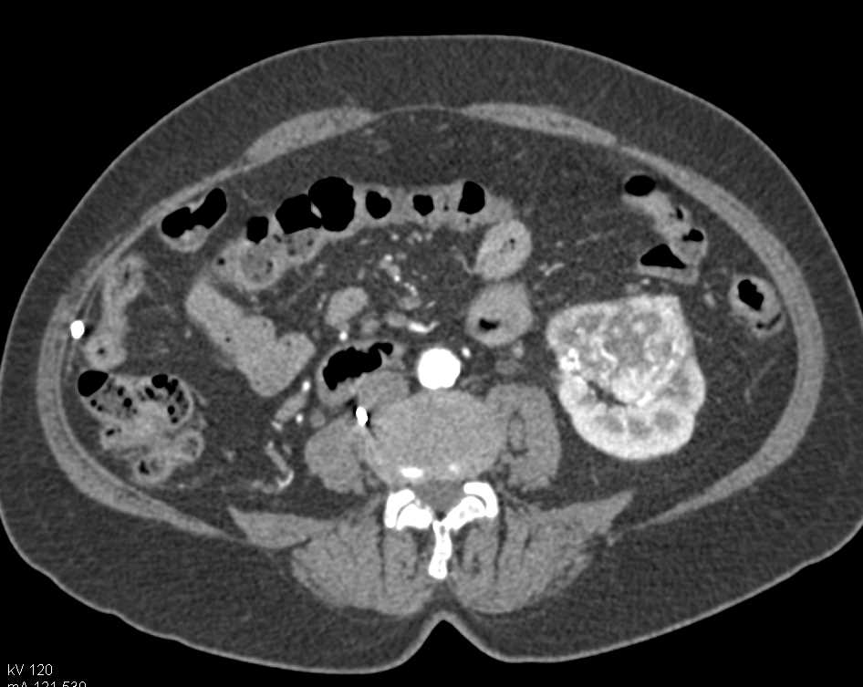 Left Clear Cell Renal Cell Carcinoma - CTisus CT Scan