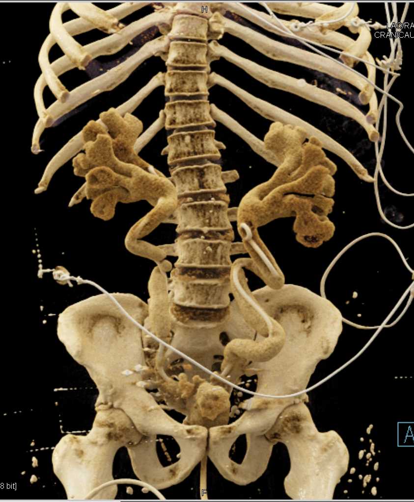 Dilated Renal Pelvises and Ureters with Cinematic Rendering - CTisus CT Scan