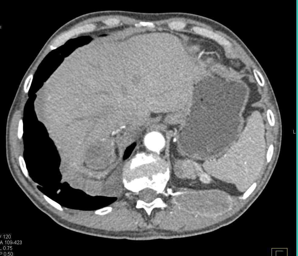 Renal Cell Carcinoma Metastatic to the Left 12th Rib - CTisus CT Scan