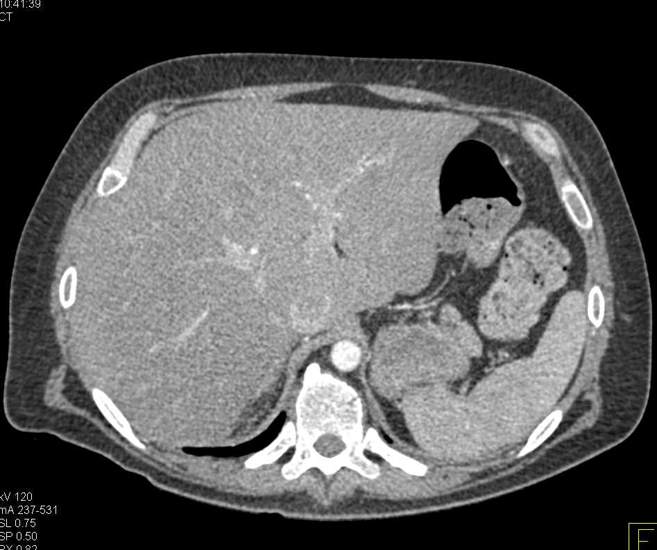 Clear Cell Renal Cell Carcinoma (RCC) Invades Right Renal Vein and Inferior Vena Cava (IVC) - CTisus CT Scan