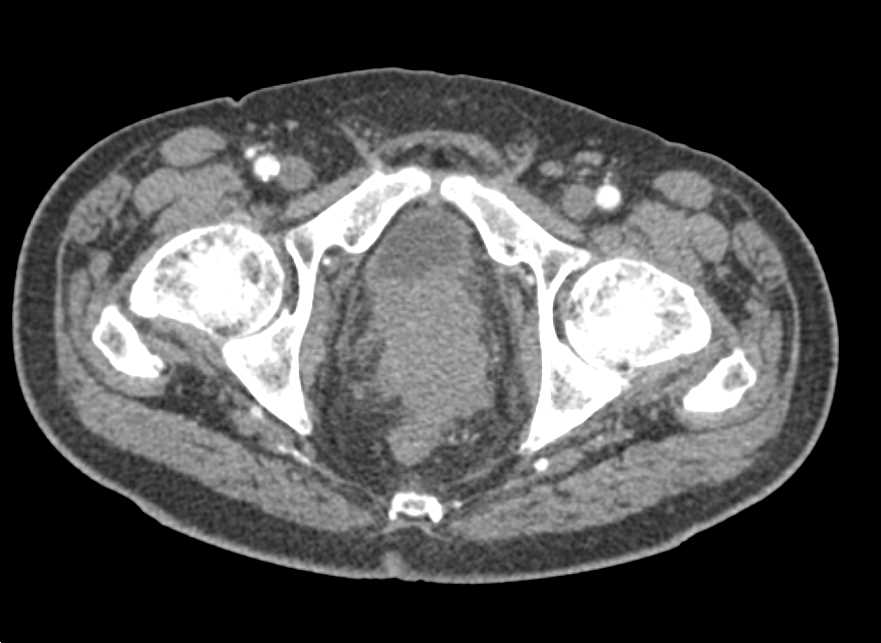 Incidental Left Renal Cell Carcinoma (RCC) in Patient with Dissection - CTisus CT Scan