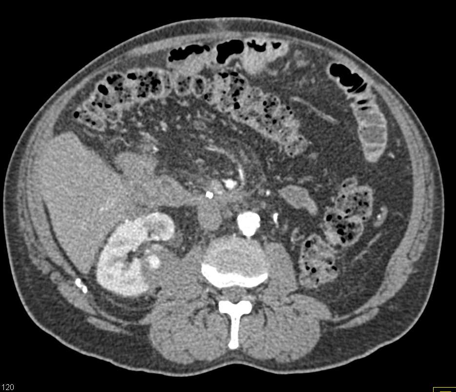 Pseudoaneurysm with Bleed s/p Ablation Right Kidney - CTisus CT Scan