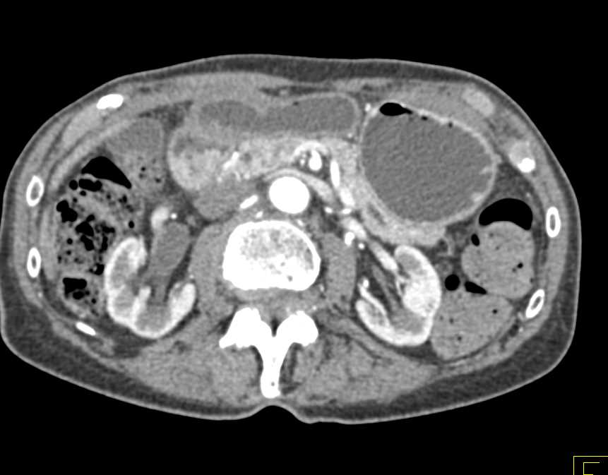 Subtle Transitional Cell Carcinoma (TCC) Right Renal Pelvis - CTisus CT Scan