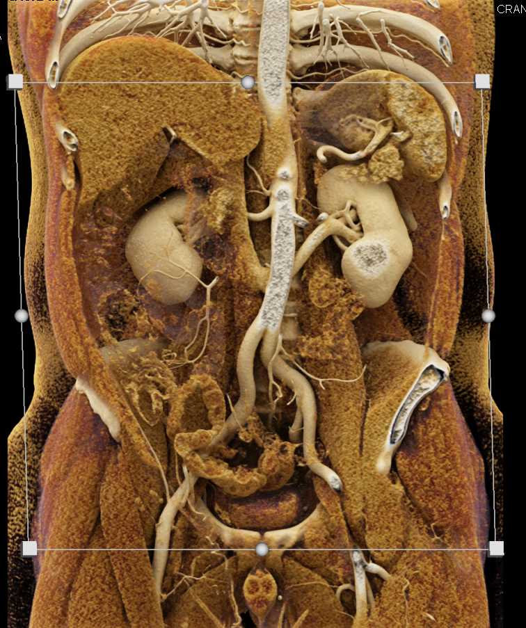 Retro-Aortic Left Renal Vein with Cinematic Rendering - CTisus CT Scan