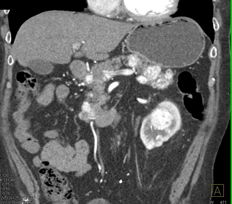 Metastatic Renal Cell Carcinoma to Contralateral Kidney and Pancreas - CTisus CT Scan