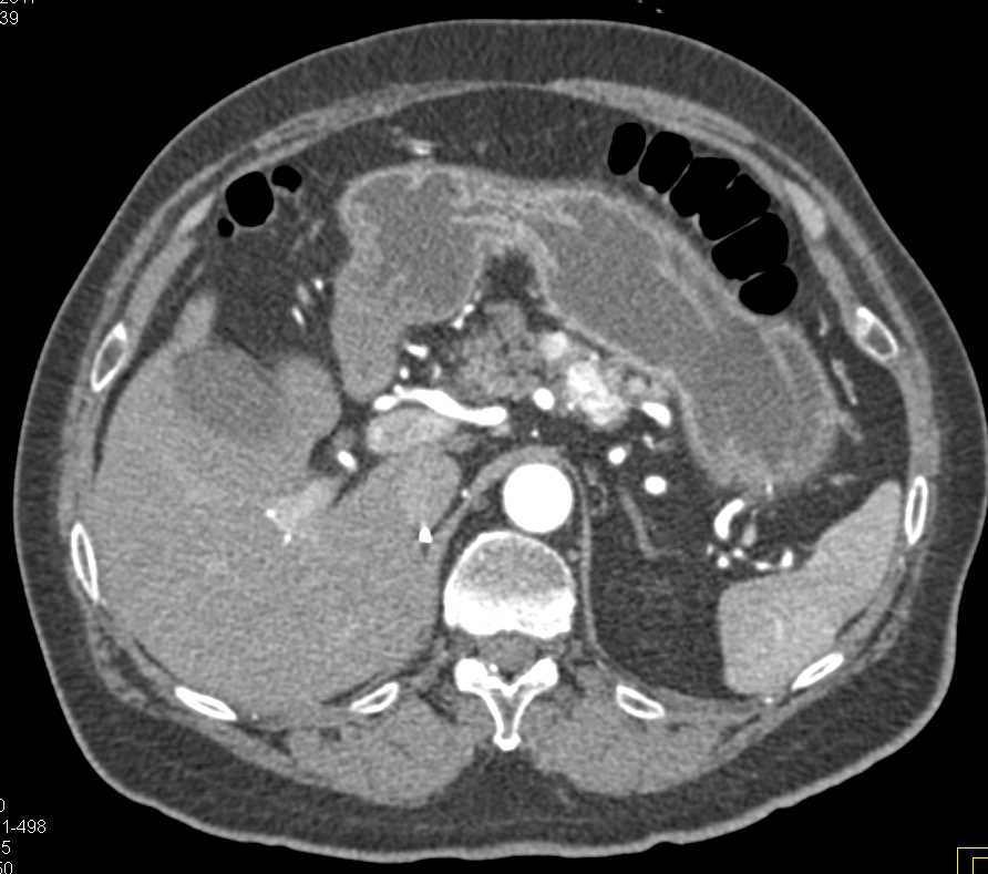 Metastatic Renal Cell Carcinoma to Contralateral Kidney and Pancreas - CTisus CT Scan