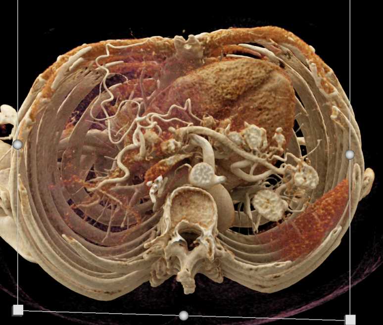 Metastatic Renal Cell Carcinoma to Contralateral Kidney and Pancreas - CTisus CT Scan