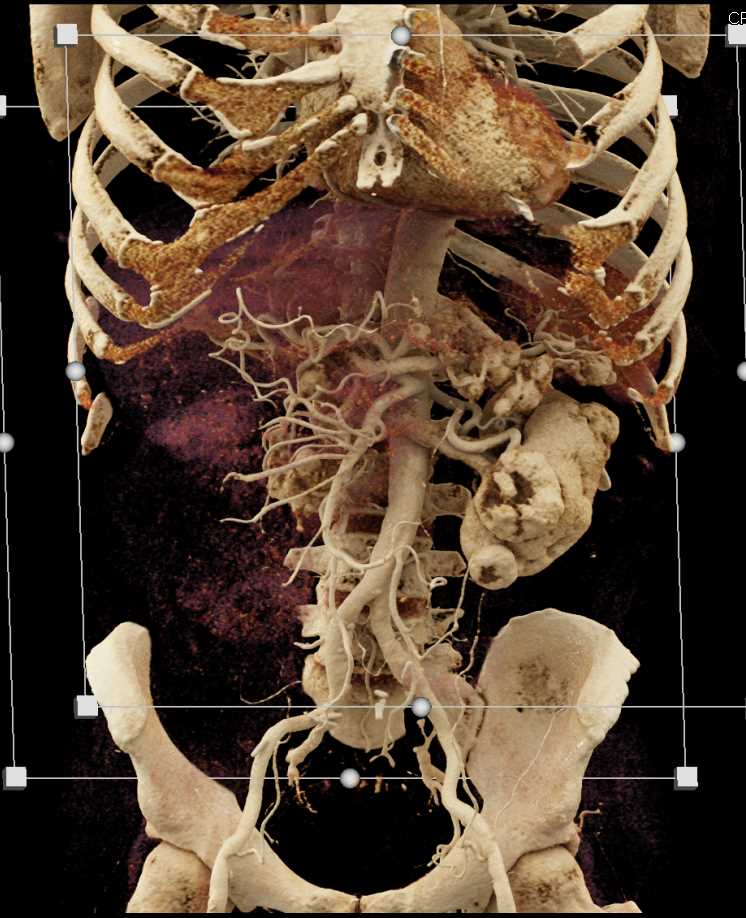 Metastatic Renal Cell Carcinoma (RCC) to Contralateral Kidney and Pancreas - CTisus CT Scan