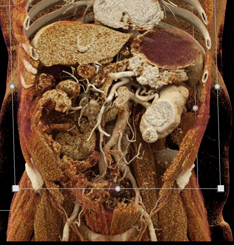 Metastatic Renal Cell Carcinoma (RCC) to Contralateral Kidney and Pancreas - CTisus CT Scan
